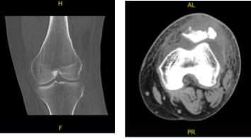 CT - Left Knee Contrast