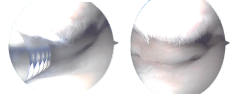 Imágenes artroscópicas intraoperatorias tomadas durante la operación