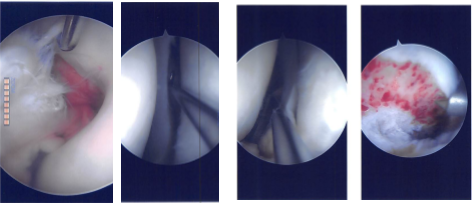 Imágenes de artroscopia intraoperatoria