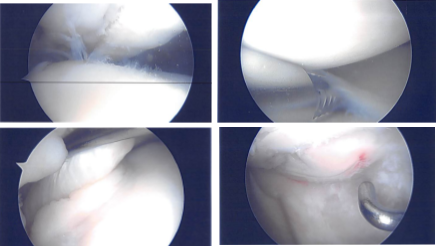Imágenes de artroscopia intraoperatoria