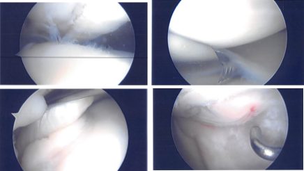 Intraoperative Arthroscopy Images