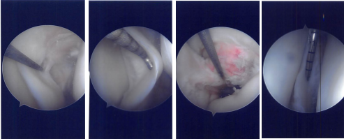 Imágenes de artroscopia intraoperatoria