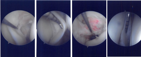 Intraoperative Arthroscopy Images