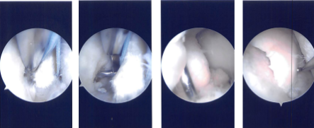 Imágenes de artroscopia intraoperatoria