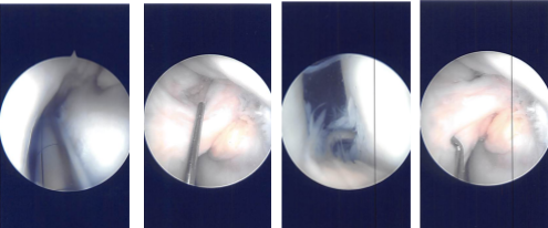 Imágenes de artroscopia intraoperatoria