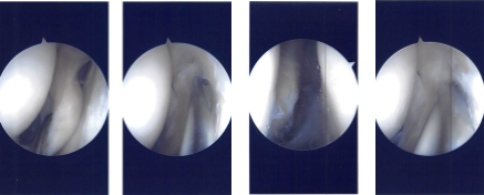 Imágenes de artroscopia intraoperatoria