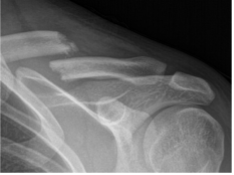 Left Clavicle in axial position