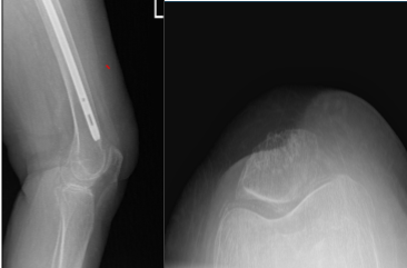 Radiografía de rodilla izquierda completa con rótula