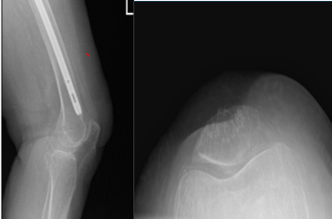 Left Knee X-ray Complete with Patella