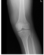 Radiografía de rodilla izquierda AP y lateral con oblicuos 3 vistas