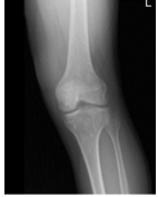 Left Knee X-ray AP and Lateral with Obliques 3 views