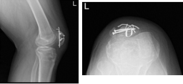 Radiografía de rodilla izquierda completa con rótula