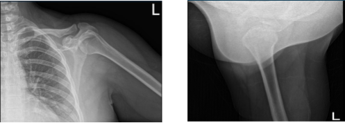 Left Shoulder X-ray