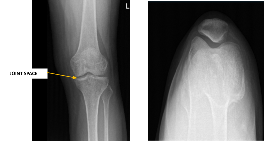 Radiografía de rodilla izquierda completa con rótula