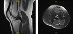 Resonancia magnética -3 T Rodilla izquierda sin contraste