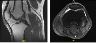 MRI - 3T Left Knee Non Contrast