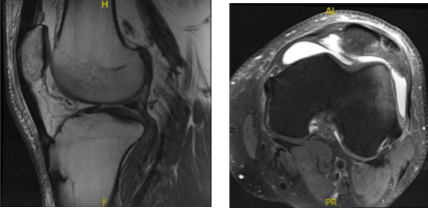 MRI - 3T Left Knee Non Contrast