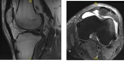 Resonancia magnética - 3T rodilla izquierda sin contraste