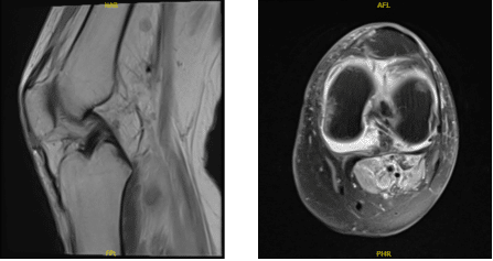 MRI-3T Left Knee non-contrast