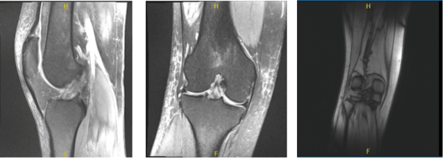 MRI-3T Right Knee non-contrast