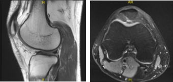 MRI-3T Rodilla derecha sin contraste