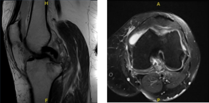 MRI-Left Knee Non-contrast
