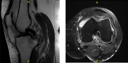 Resonancia magnética de rodilla izquierda sin contraste