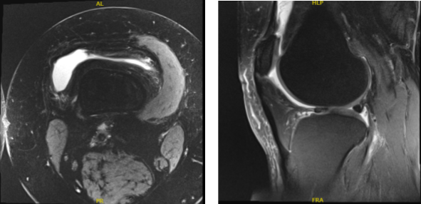 MRI - Right Knee Non-Contrast