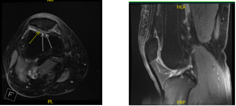 MRI Right knee non-contrast