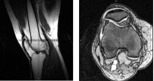 Magnetic resonance imaging of the right knee