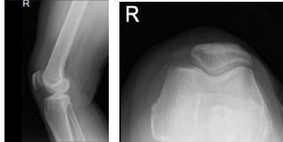 Radiografía de rodilla derecha AP y lateral