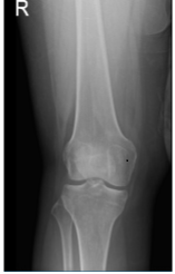 Right Knee X-ray