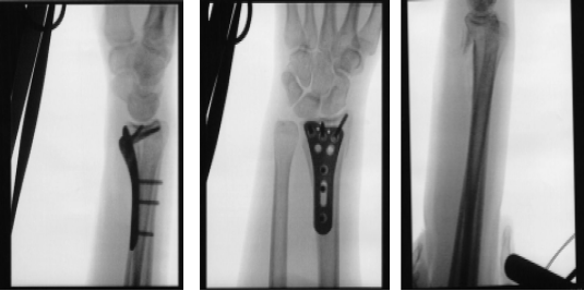 X-ray wrist 3 or more view