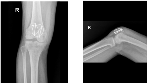 X-ray Image right knee