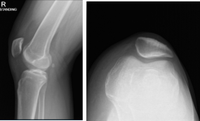 Radiografía de rodilla derecha completa con rótula