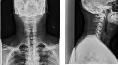 X-ray cervical spine 2 or 3 views