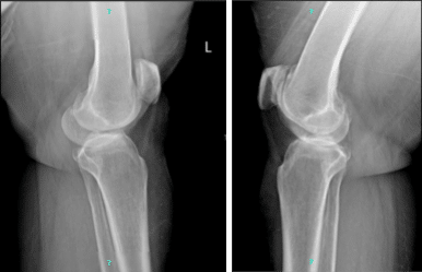 Left and right knee x-ray complete patella