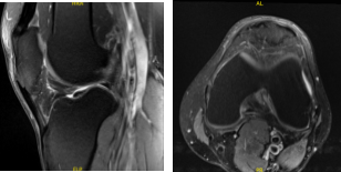 MRI-3T Left Knee non-contrast