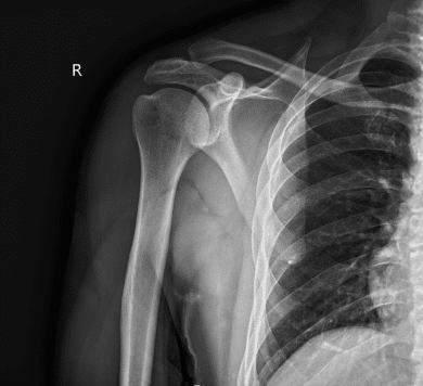 X-ray right shoulder minimum 2 views