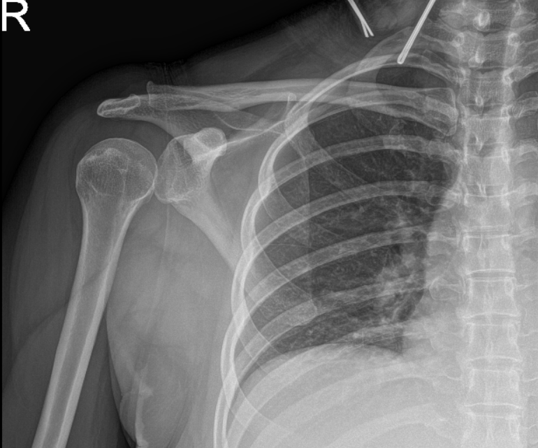 Right shoulder X-ray