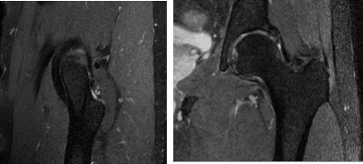 MRI Left Hip non-contrast