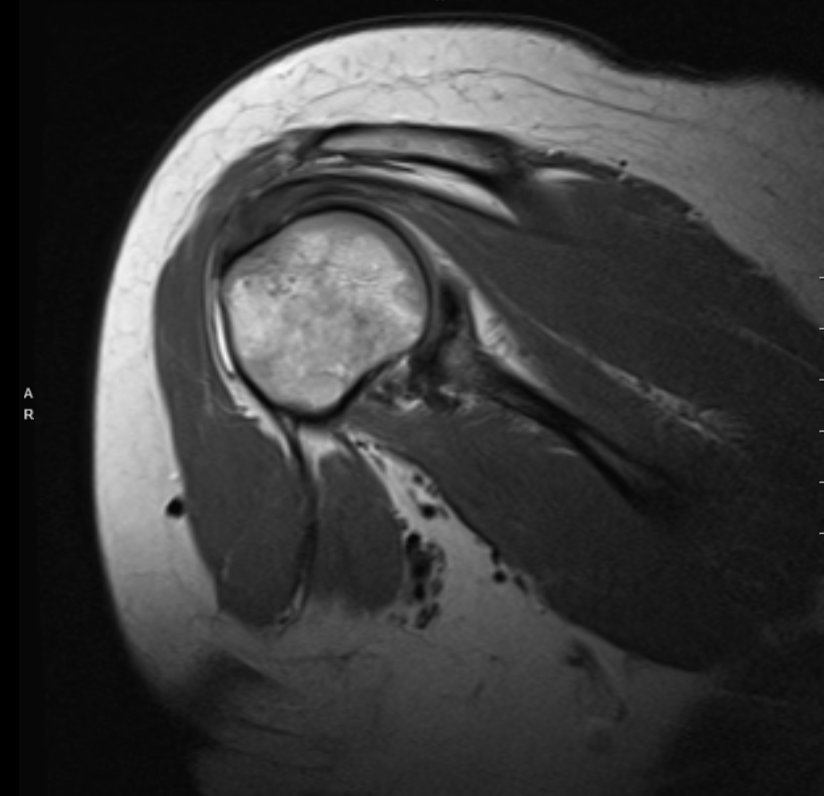 MRI Scan of the right shoulder