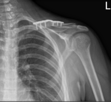 Resultados de la radiografía de 4 semanas de la clavícula izquierda después de la cirugía