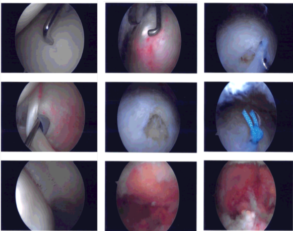 Arthroscopic images taken during the surgery