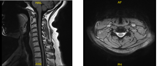 MRI-3T Cervical Spine non-contrast