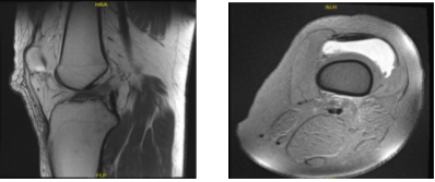 MRI-3T Left knee non-contrast