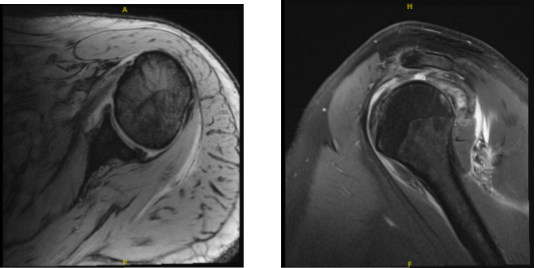 MRI-3T Left shoulder non-contrast