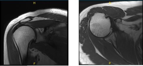 MRI-3T Right shoulder non-contrast