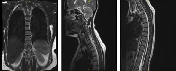 MRI-3T Thoracic Spine non-contrast
