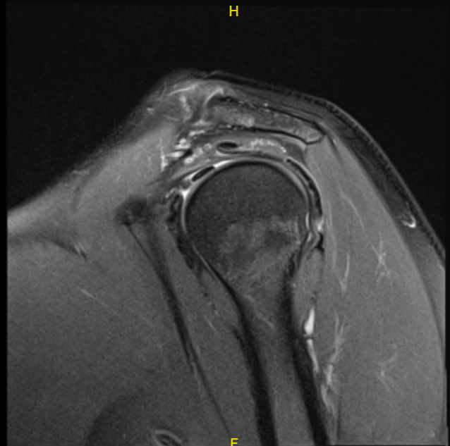 MRI-3T left shoulder non-contrast